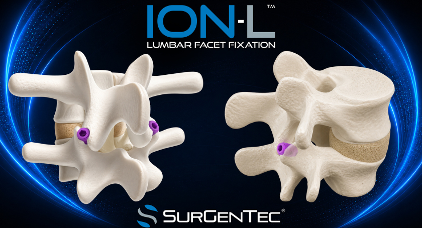 FDA Clears SurGenTec’s Lumbar Facet Fixation System